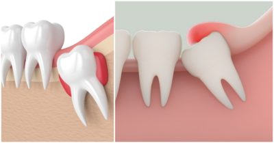 Nhổ răng khôn: Những điều cần biết
