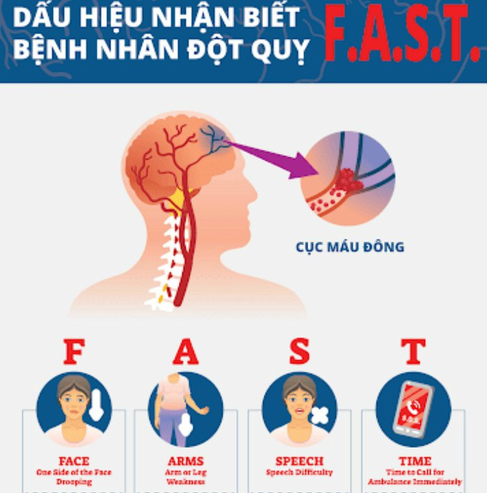 Có thể nhận biết sớm nguy cơ tai biến với quy tắc F.A.S.T để nhanh chóng đưa bệnh nhân  đi cấp cứu... Yếu tố nguy cơ chính của tai biến là huyết áp cao. Các yếu tố nguy cơ khác bao gồm hút thuốc lá, béo phì, cholesterol trong máu cao, đái tháo đường, TIA trước đó và rung tâm nhĩ. tai biến do thiếu máu cục bộ thường gây ra do tắc nghẽn mạch máu, mặc dù cũng có những nguyên nhân ít phổ biến hơn. tai biến xuất huyết là do chảy máu trực tiếp vào não hoặc vào khoảng trống giữa màng não. Chảy máu có thể xảy ra do phình động mạch não bị vỡ.[5] Chẩn đoán thường dựa trên khám thực thể và được hỗ trợ bằng hình ảnh y tế như chụp CT hoặc quét MRI. Chụp CT có thể loại trừ chảy máu, nhưng có thể không nhất thiết loại trừ thiếu máu cục bộ, mà sớm không thường xuất hiện trên CT scan. Các xét nghiệm khác như một điện tâm đồ (ECG) và xét nghiệm máu được thực hiện để xác định các yếu tố nguy cơ và loại trừ nguyên nhân có thể khác. Lượng đường trong máu thấp có thể gây ra các triệu chứng tương tự.
