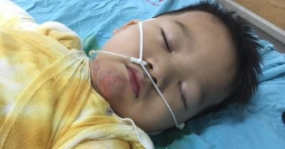 Xót xa cảnh cậu bé ngã vào nồi canh nóng, bỏng nặng nguy kịch